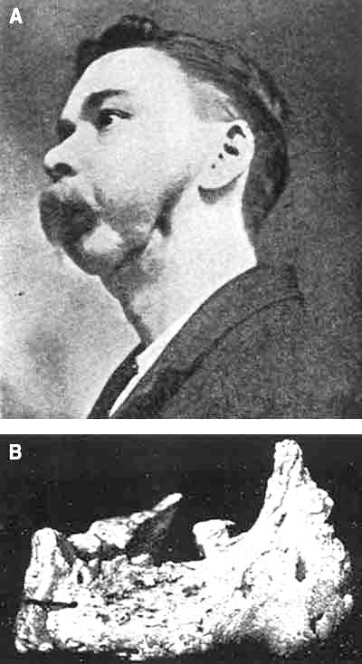 London Hospital Medical College Museum A case of phossy jaw